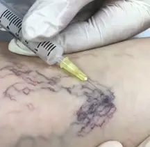 Spider veins (telangiectasias) disappearing almost immediately